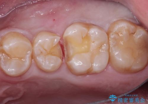 むし歯発見!e-max インレー(プレス)の治療中