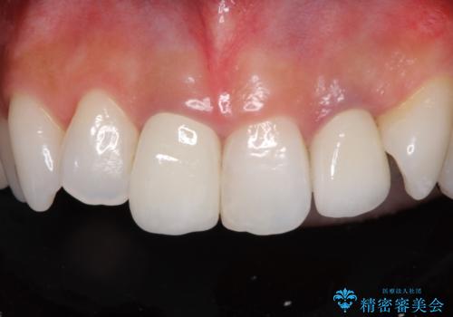 裏打ちが金属のセラミッククラウンをオールセラミッククラウンで自然にの治療後