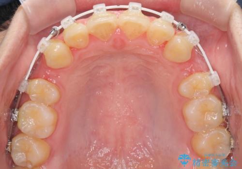 口元が出てるの気になる、引っ込めたい ワイヤーによる抜歯矯正で横顔の改善の治療中
