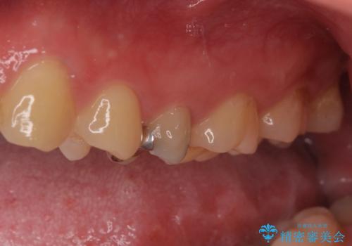 割れた歯を引っ張り出す　右上と左上の虫歯治療の治療前