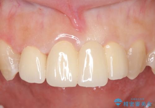 オールセラミッククラウン　変色した前歯を白く綺麗な歯への症例 治療後