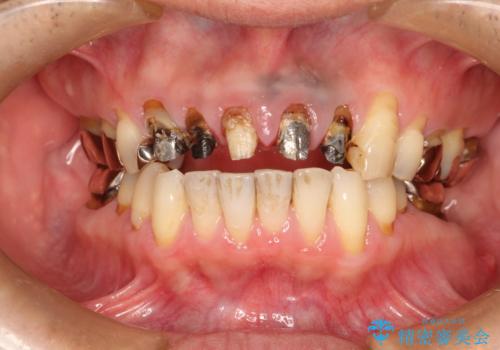 上の前歯の根元が黒い 根の治療を含めたセラミック再治療の治療前