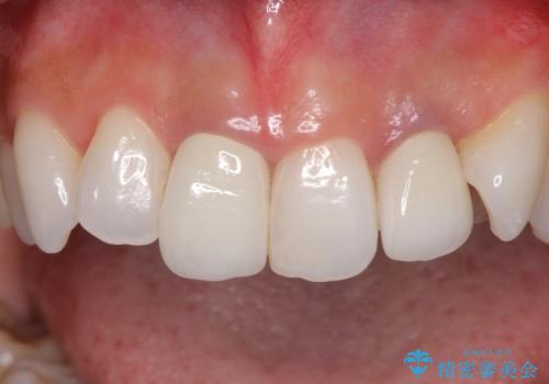 裏打ちが金属のセラミッククラウンをオールセラミッククラウンで自然にの治療後