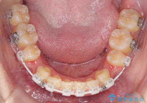 口元が出てるの気になる、引っ込めたい ワイヤーによる抜歯矯正で横顔の改善の治療中