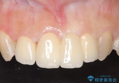 オールセラミッククラウン　変色した前歯を白く綺麗な歯への治療後