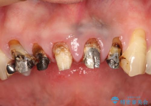 上の前歯の根元が黒い　根の治療を含めたセラミック再治療の治療前