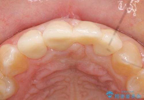 オールセラミッククラウン 変色した前歯を白く綺麗な歯への治療後