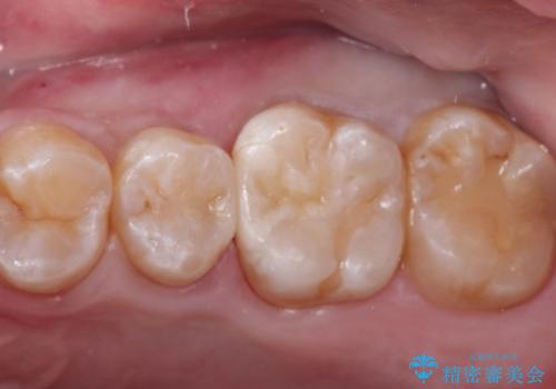 むし歯発見!e-max インレー(プレス)の症例 治療後