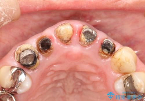 上の前歯の根元が黒い　根の治療を含めたセラミック再治療の治療前