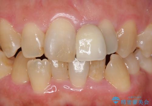 オールセラミッククラウン 変色した前歯を白く綺麗な歯への治療前