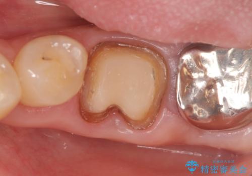 オールセラミッククラウン 外れてしまった銀歯の治療の治療中