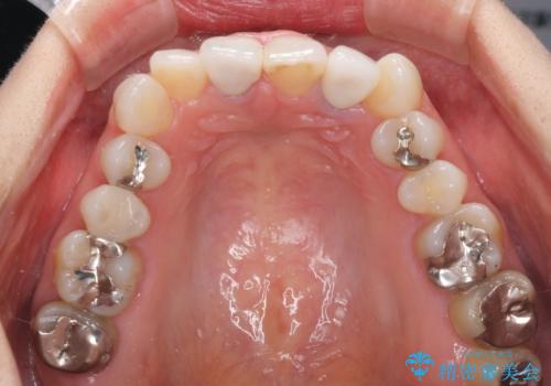 裏打ちが金属のセラミッククラウンをオールセラミッククラウンで自然にの治療後