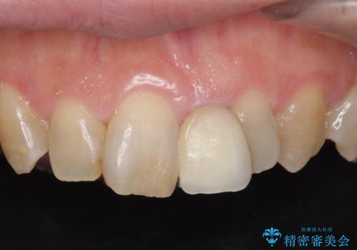 オールセラミッククラウン　変色した前歯を白く綺麗な歯への治療前