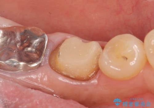 オールセラミッククラウン 外れてしまった銀歯の治療の治療中