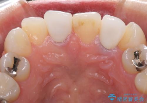 裏打ちが金属のセラミッククラウンをオールセラミッククラウンで自然にの治療後