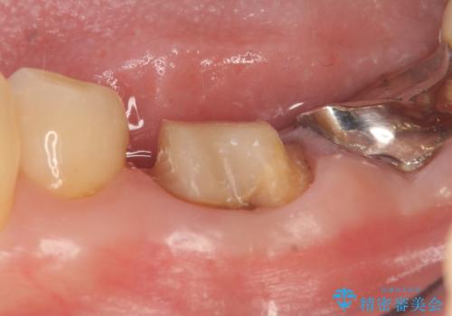 オールセラミッククラウン 外れてしまった銀歯の治療の治療中