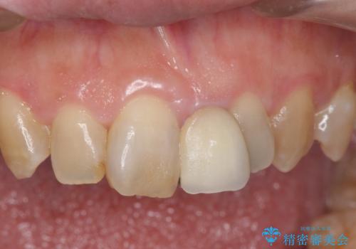 オールセラミッククラウン　変色した前歯を白く綺麗な歯への症例 治療前