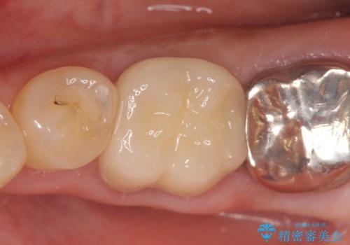 オールセラミッククラウン 外れてしまった銀歯の治療の治療後