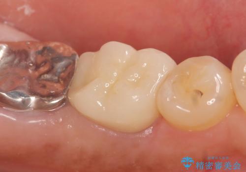オールセラミッククラウン 外れてしまった銀歯の治療の治療後