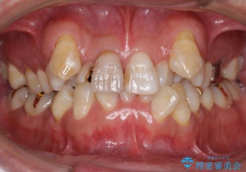 奥に引っ込んでいる歯をセラミックでかぶせたい 補綴前矯正 50代男性の治療前