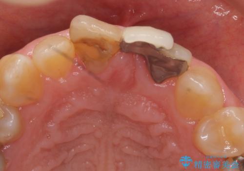オールセラミッククラウン 変色した前歯を白く綺麗な歯への治療前