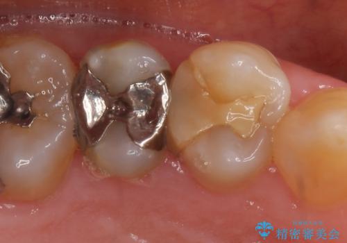 セラミックインレー 古い樹脂の修復の症例 治療前