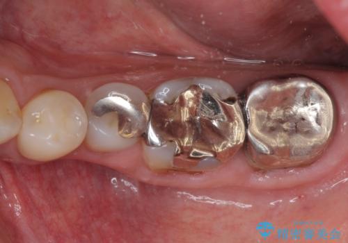 奥歯の虫歯と歯茎の腫れをセラミッククラウンで治療の治療前