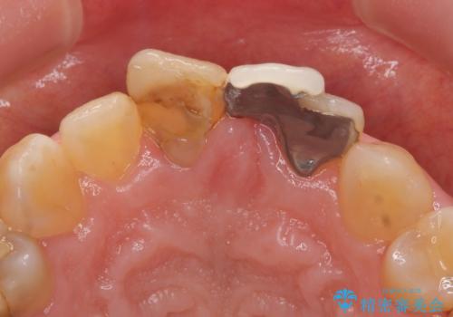 オールセラミッククラウン 変色した前歯を白く綺麗な歯への治療前