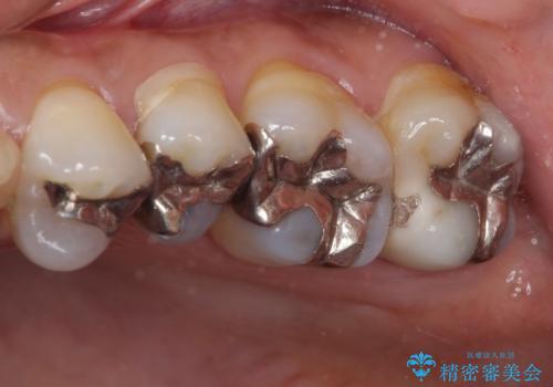 奥歯の虫歯と歯茎の腫れをセラミッククラウンで治療の治療前