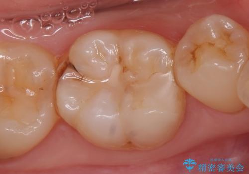 セラミックインレー しみる歯の歯の治療の治療前