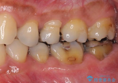 奥歯の虫歯と歯茎の腫れをセラミッククラウンで治療の治療前