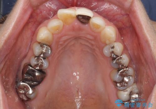 奥歯の虫歯と歯茎の腫れをセラミッククラウンで治療の治療前