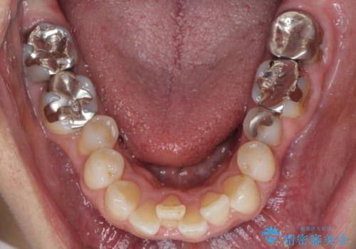 奥歯の虫歯と歯茎の腫れをセラミッククラウンで治療の治療前