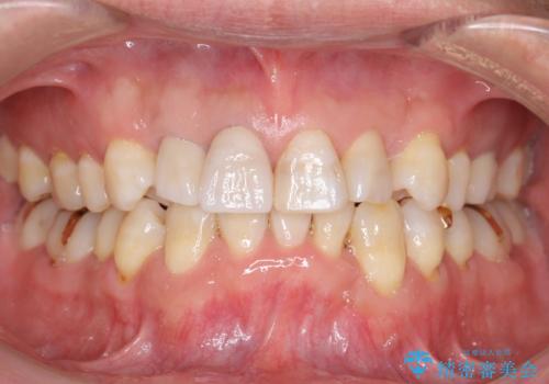 奥に引っ込んでいる歯をセラミックでかぶせたい 補綴前矯正 50代男性の治療後