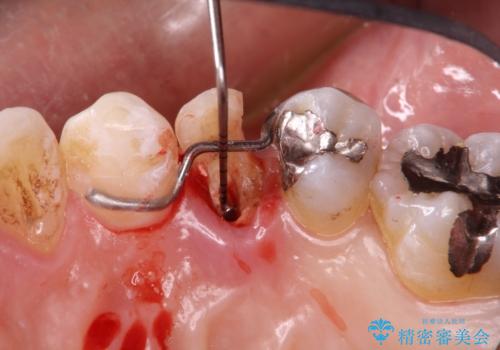 深いむし歯。根本的な治療の治療中