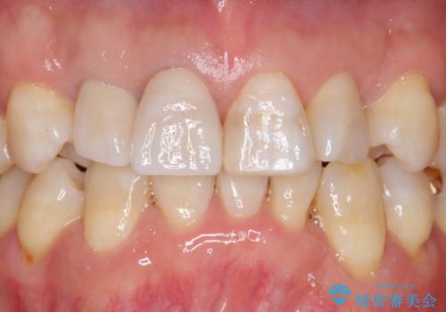奥に引っ込んでいる歯をセラミックでかぶせたい 補綴前矯正 50代男性の治療後