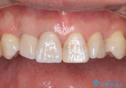奥に引っ込んでいる歯をセラミックでかぶせたい 補綴前矯正 50代男性の治療後