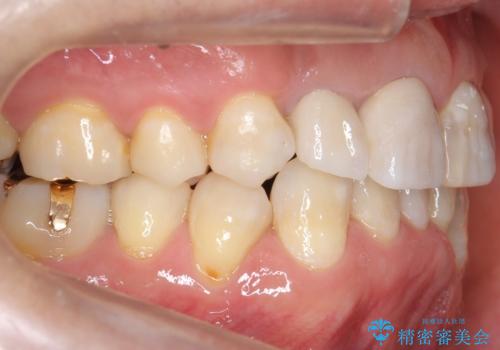 奥に引っ込んでいる歯をセラミックでかぶせたい 補綴前矯正 50代男性の治療後