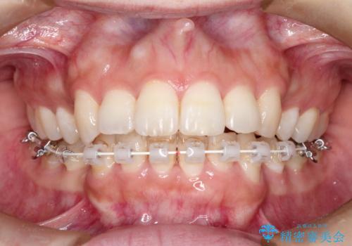 前歯のガタガタと出っ歯が気になる　ハーフリンガルによる抜歯矯正の治療中