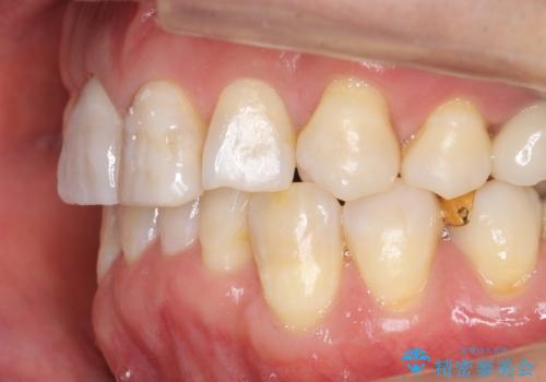 奥に引っ込んでいる歯をセラミックでかぶせたい 補綴前矯正 50代男性の治療後