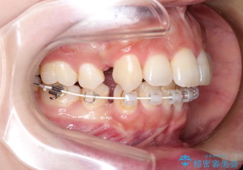 前歯のガタガタと出っ歯が気になる ハーフリンガルによる抜歯矯正の治療中