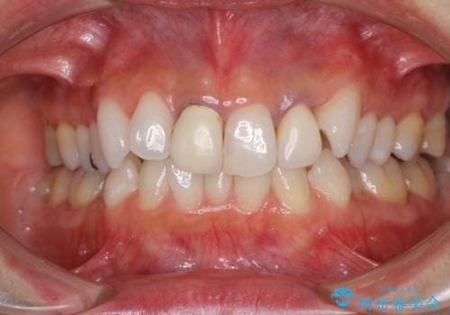 裏打ちが金属のセラミッククラウンをオールセラミッククラウンで自然にの治療前