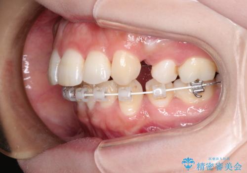 前歯のガタガタと出っ歯が気になる ハーフリンガルによる抜歯矯正の治療中