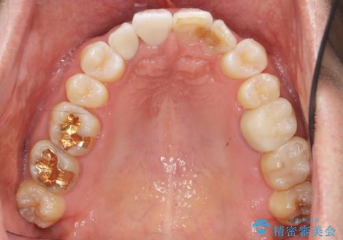 奥に引っ込んでいる歯をセラミックでかぶせたい 補綴前矯正 50代男性の治療後