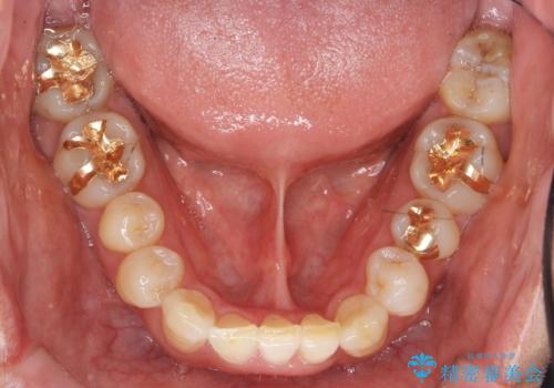 奥に引っ込んでいる歯をセラミックでかぶせたい 補綴前矯正 50代男性の治療後