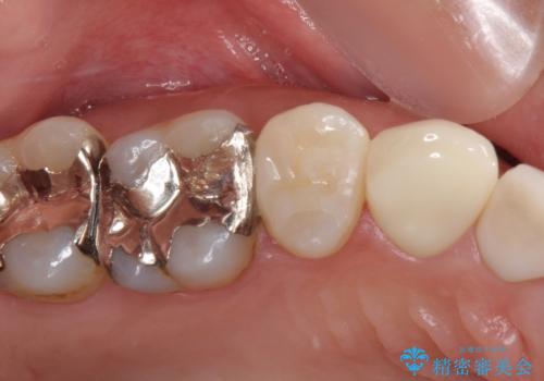 痛みが続く銀歯をセラミックにの症例 治療後
