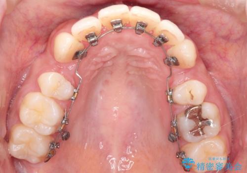 前歯のガタガタと出っ歯が気になる　ハーフリンガルによる抜歯矯正の治療中
