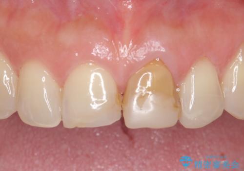 オールセラミッククラウン 変色が気になる前歯の治療の症例 治療前