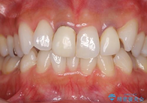 裏打ちが金属のセラミッククラウンをオールセラミッククラウンで自然にの治療前