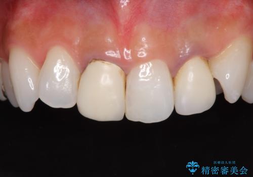 裏打ちが金属のセラミッククラウンをオールセラミッククラウンで自然にの治療前